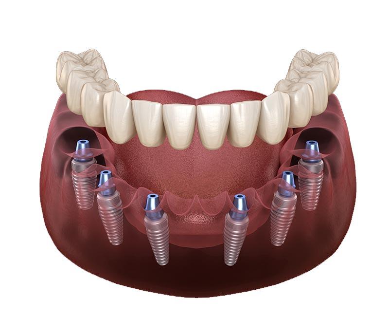all on 6 dental implants Turkey